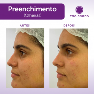 Preenchimento Olheira Fotos  Antes e Depois